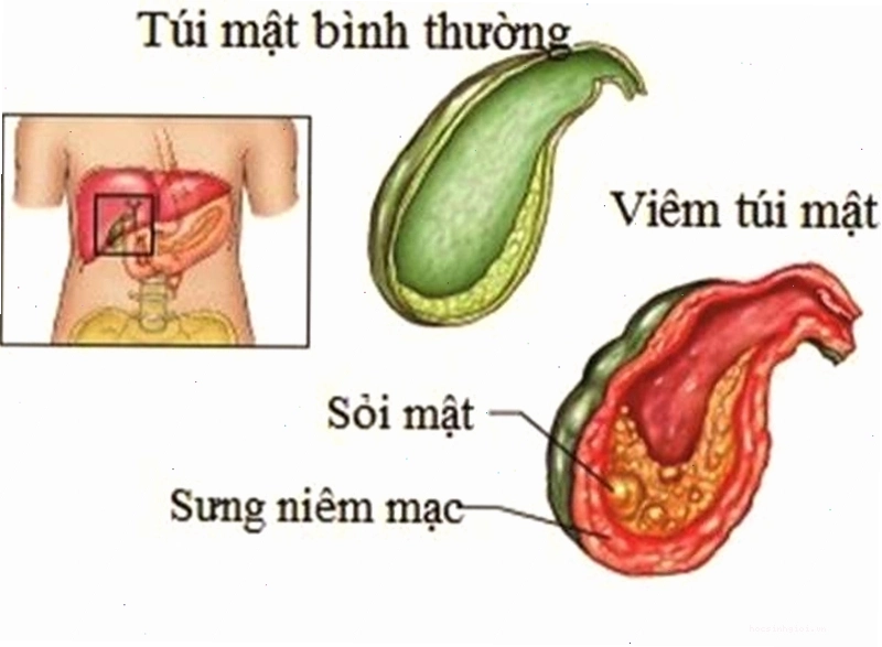 Hình ảnh minh họa túi mật bị ảnh hưởng bởi sỏi mật
