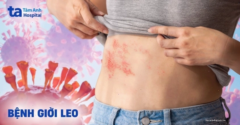 Hình ảnh minh họa virus Varicella-Zoster