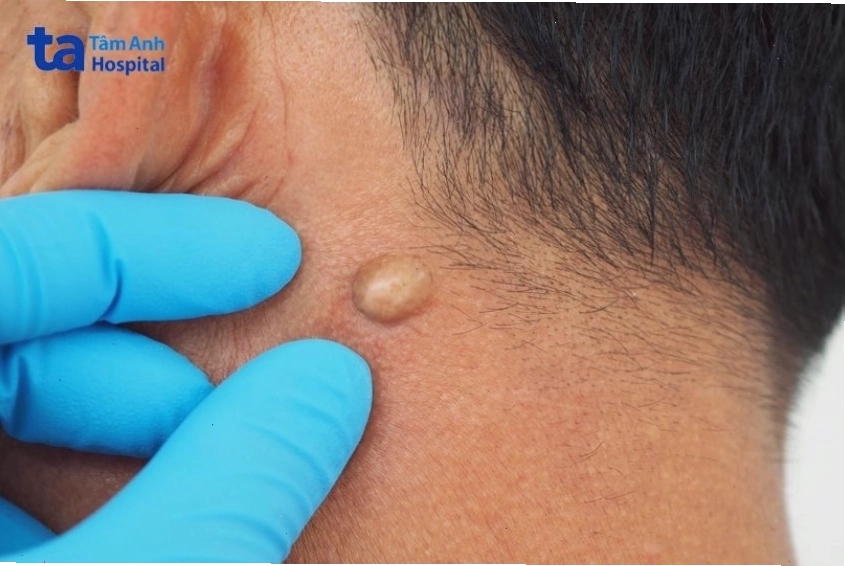 Không nên tự ý điều trị u bã đậu tại nhà để tránh biến chứng