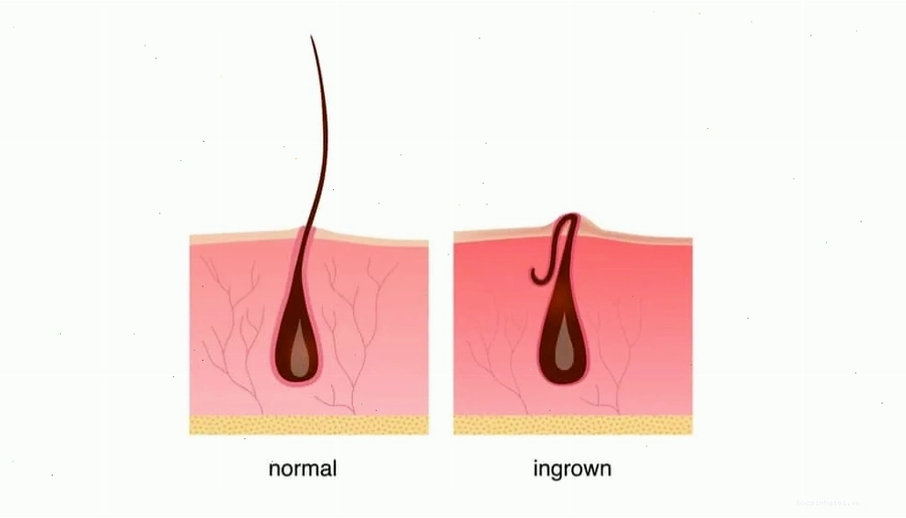 Lá trầu không có tác dụng kháng khuẩn và giảm viêm