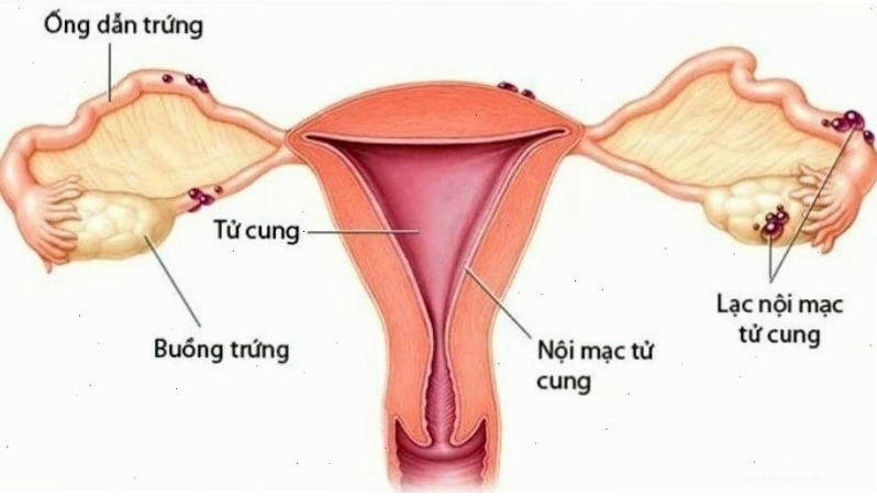 Lạc nội mạc tử cung gây đau vùng chậu dữ dội