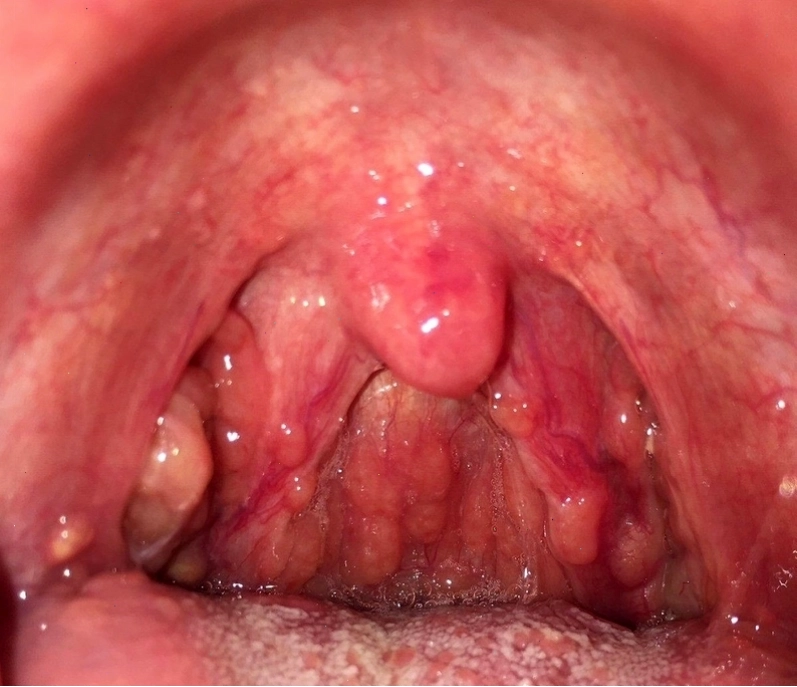 Lối sống lành mạnh giúp phòng ngừa các bệnh về cổ họng