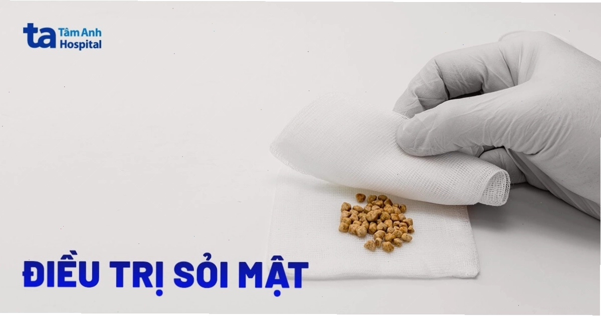 Minh họa phương pháp điều trị sỏi mật