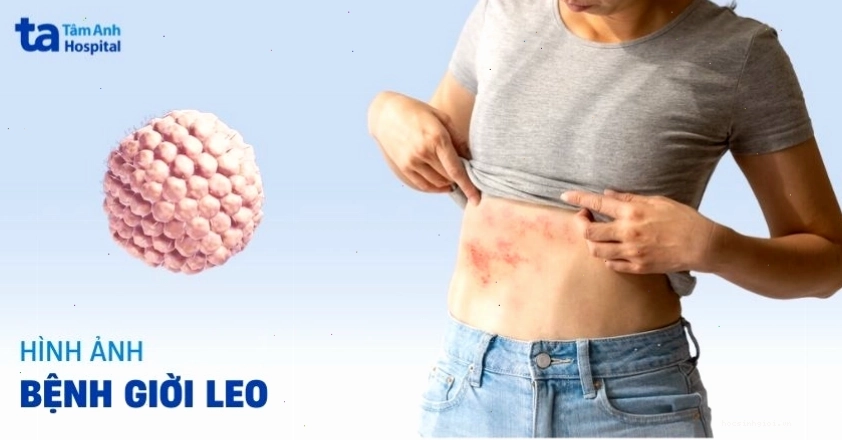 Mụn nước giời leo giai đoạn phát triển