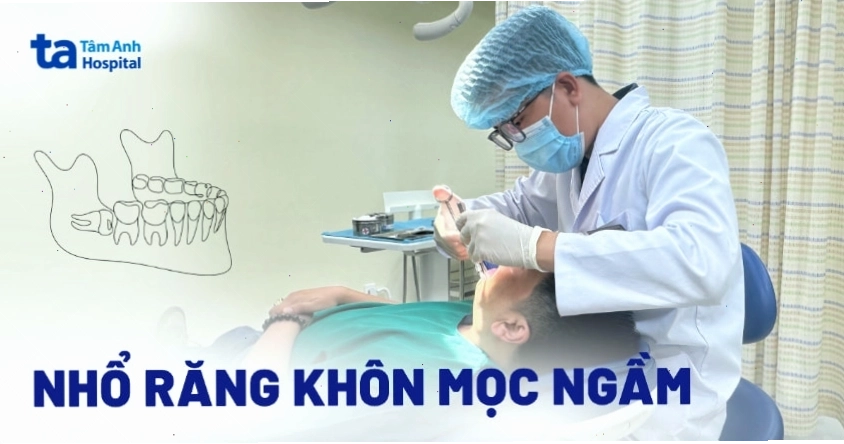 Nhổ răng khôn mọc ngầm và cách chăm sóc sau đó