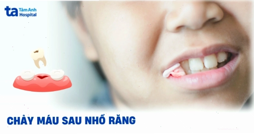 Những điều cần tránh để cầm máu sau nhổ răng