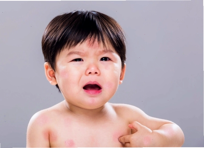 Nổi mề đay và ngứa da là triệu chứng phổ biến của dị ứng thức ăn