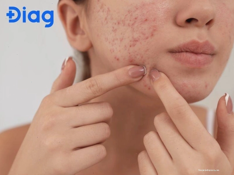 Nữ thay đổi da và tuyến mồ hôi nên dễ nổi mụn hơn