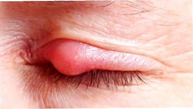 Phương pháp cột chỉ dân gian để trị mụt lẹo mắt