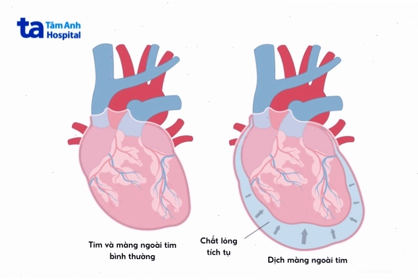 So sánh hình ảnh trái tim bình thường và trái tim bị chèn ép do dịch màng ngoài tim