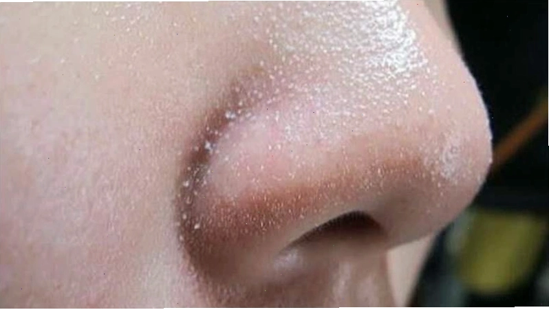 Sợi bã nhờn là các cấu trúc tự nhiên nằm sâu trong nang lông hoặc xuất hiện trên bề mặt da