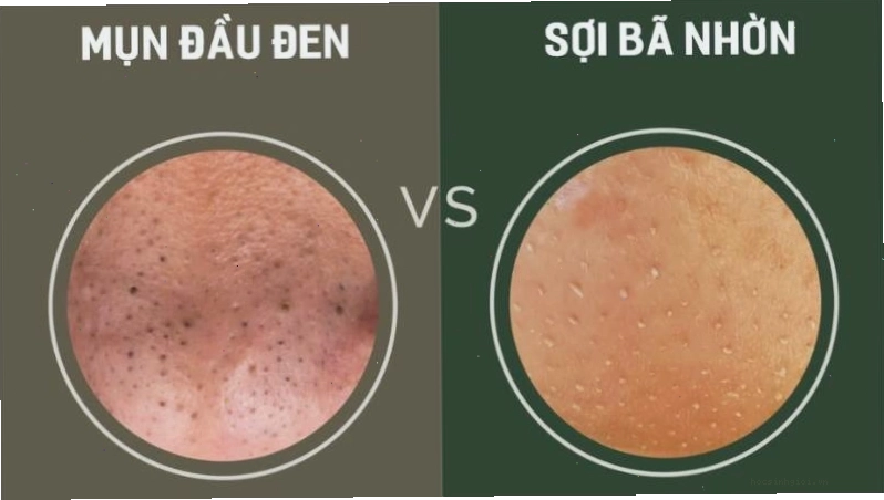 Sợi bã nhờn và mụn đầu đen có nhiều điểm khác biệt
