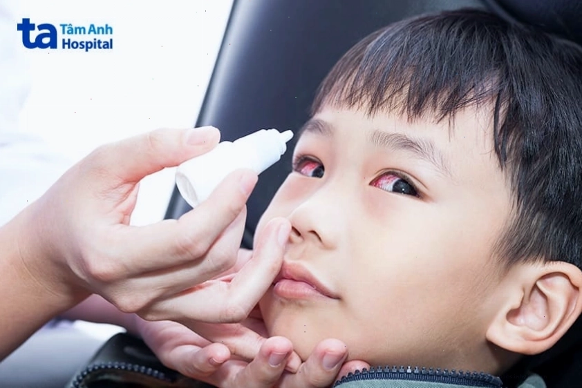 Sử dụng nước muối sinh lý để vệ sinh mắt bị đau mắt đỏ