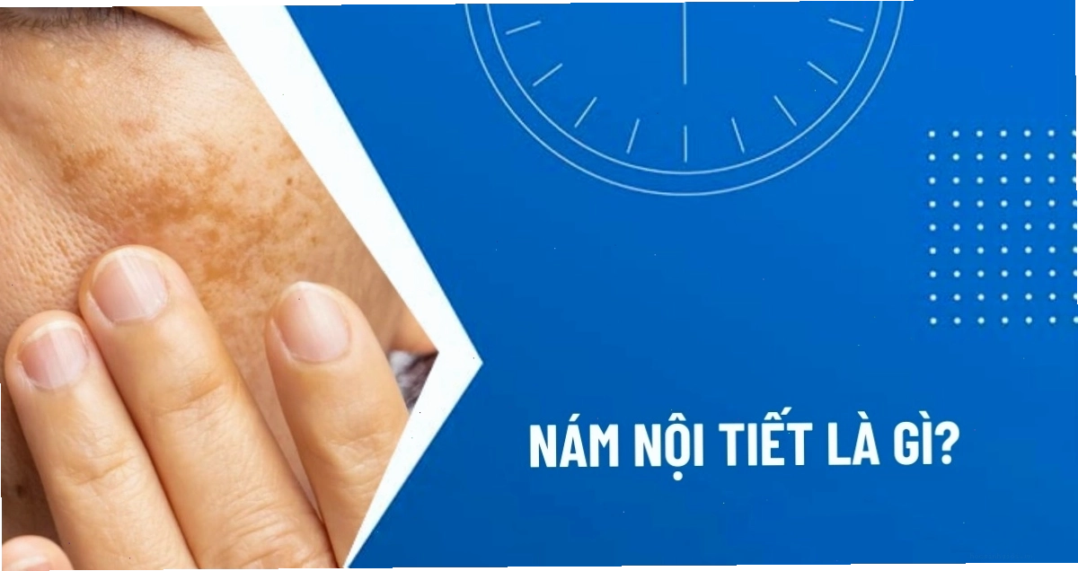 Sự thay đổi nội tiết tố là một trong những nguyên nhân chính gây nám chân sâu