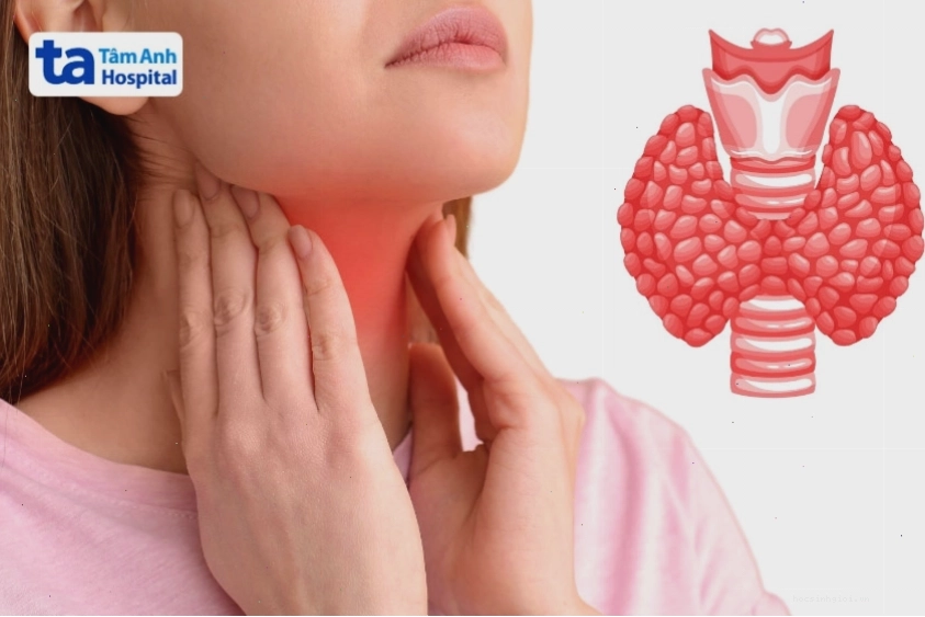 Suy giáp là một trong những nguyên nhân gây tích tụ dịch màng ngoài tim