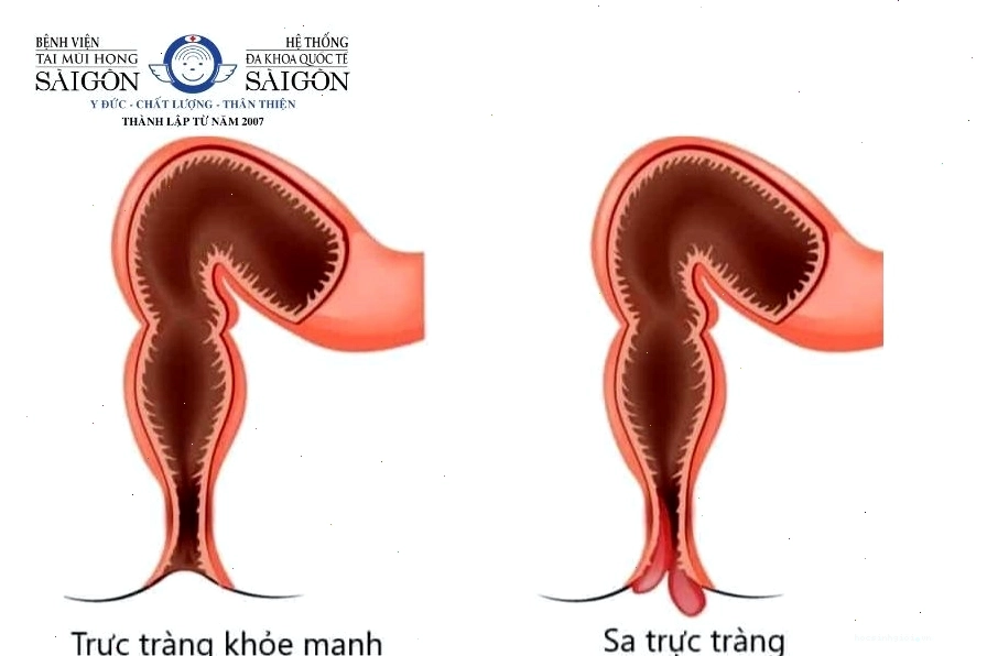 Táo bón kéo dài có thể dẫn đến các biến chứng nguy hiểm