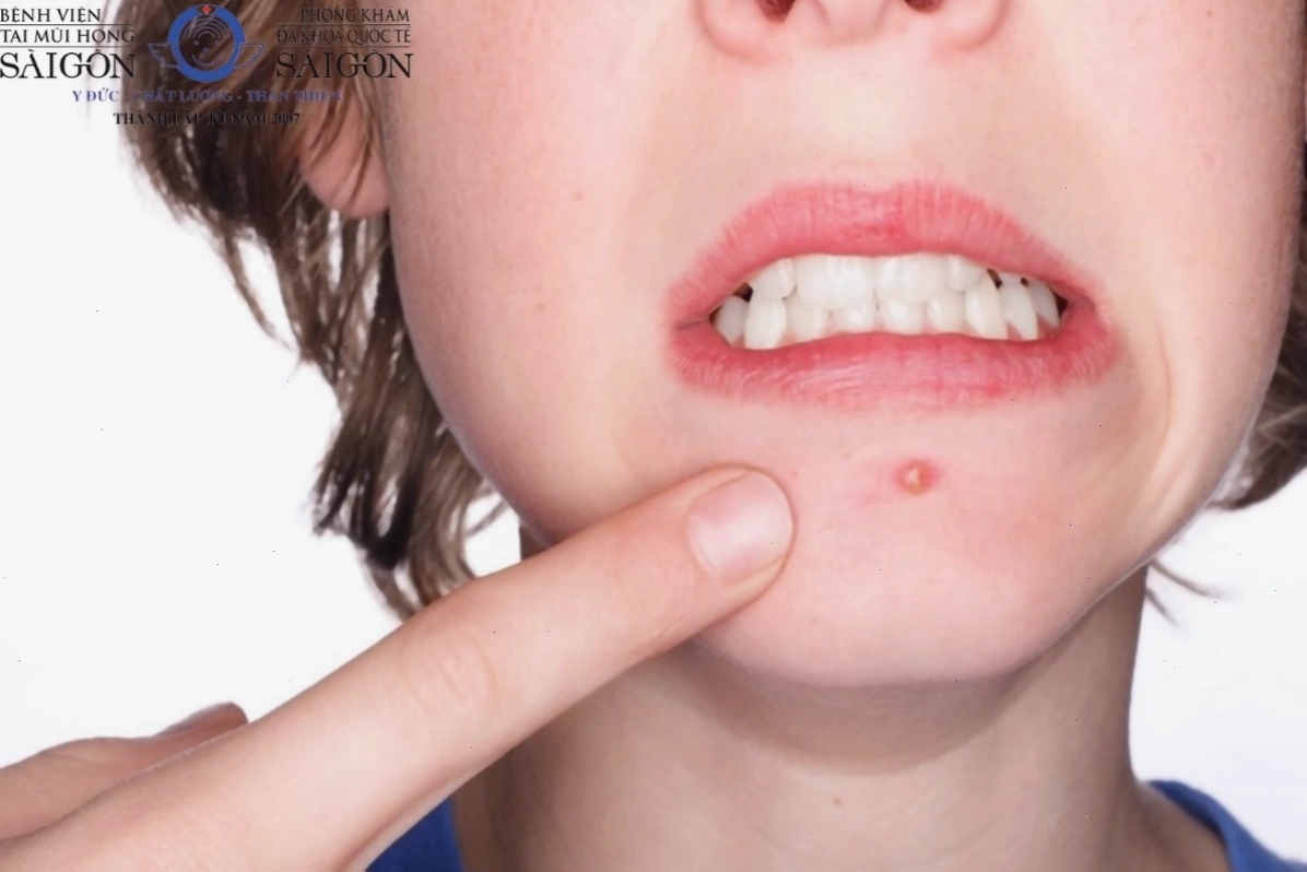 Thói quen nặn mụn quanh miệng có thể làm tình trạng mụn đinh râu trở nên nghiêm trọng hơn