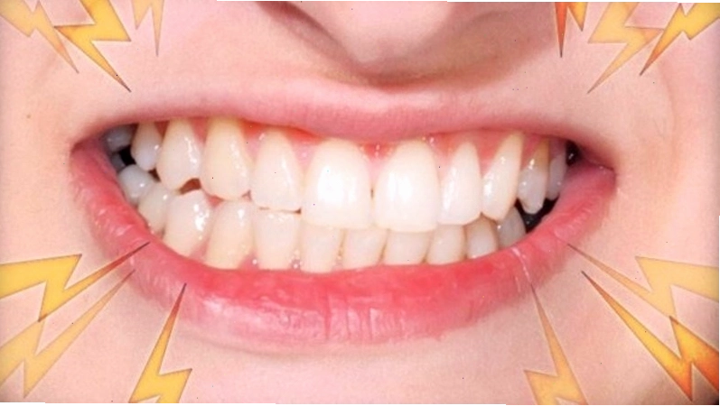 Thói quen nghiến răng quá mạnh, đặc biệt là vào ban đêm, có thể làm hư tổn men răng