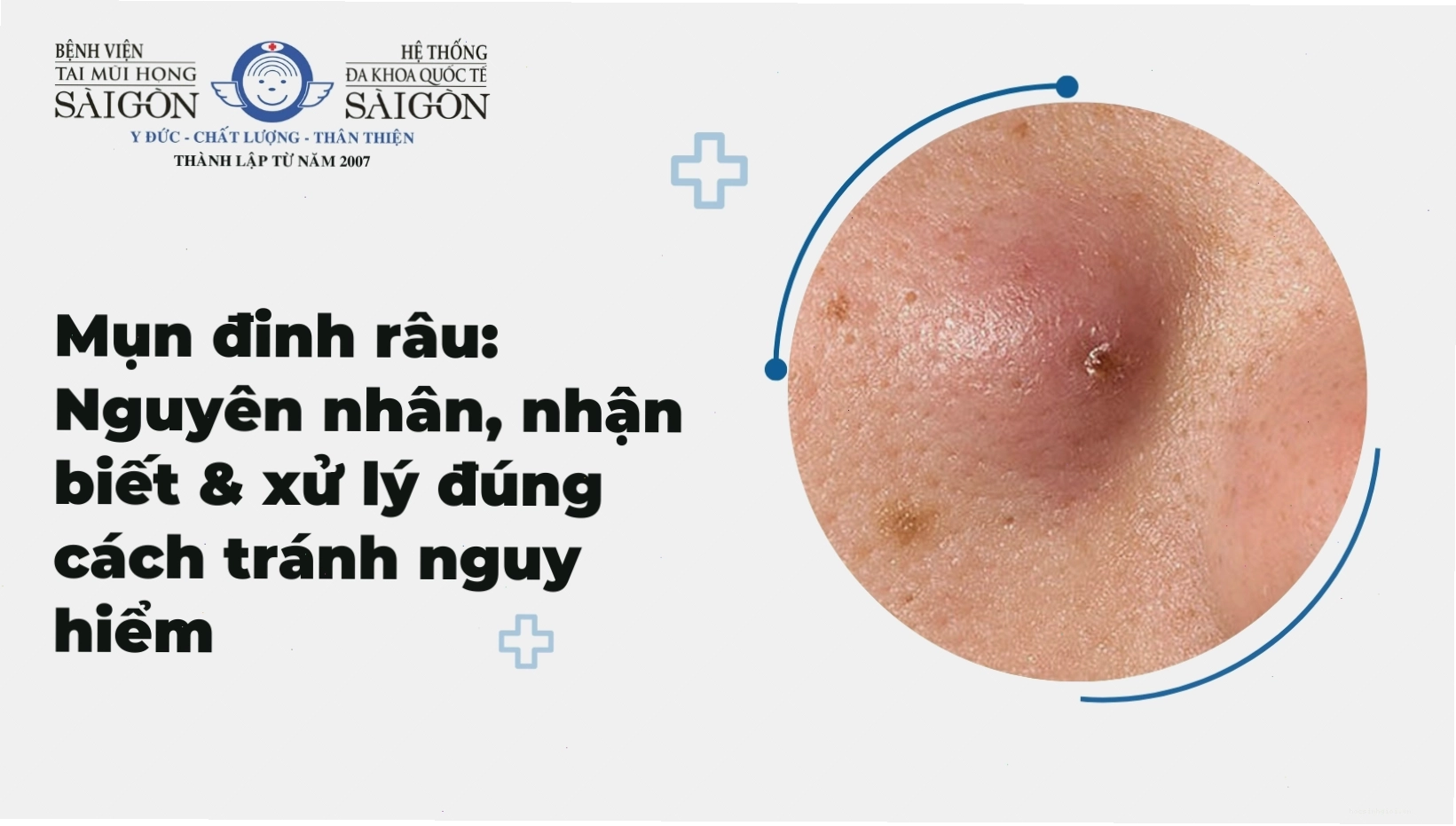 Tổng quan về mụn đinh râu, nguyên nhân, cách nhận biết và xử lý an toàn
