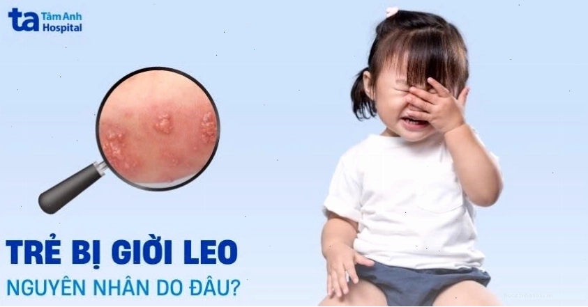 Trẻ em bị giời leo