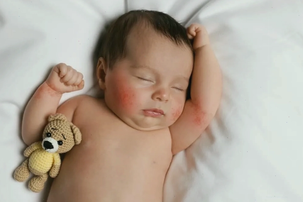 Trẻ sơ sinh bị chàm sữa ở má