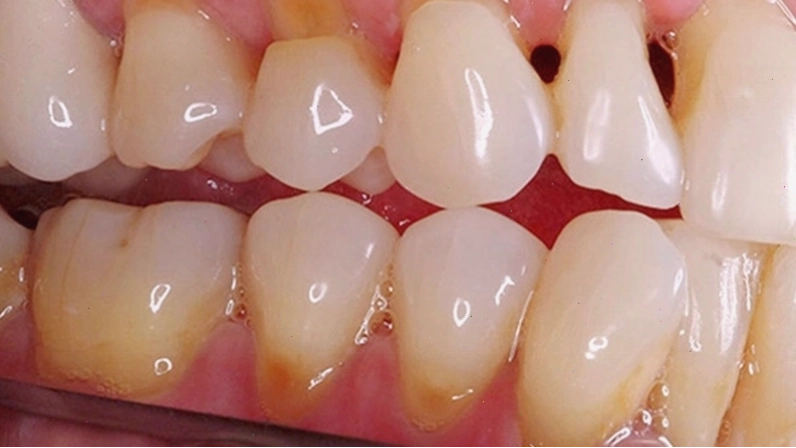 Tụt lợi răng làm lộ chân răng, gây ê buốt và tăng nguy cơ sâu răng