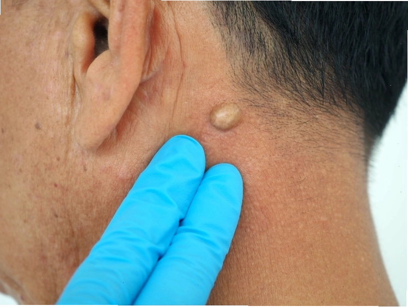 U bã đậu là một dạng u có cấu trúc dạng nang, bên trong chứa chất bã đặc quánh
