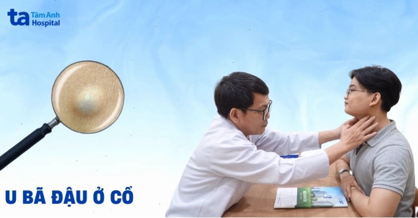 U bã đậu ở cổ: Nguyên nhân, triệu chứng, cách điều trị, phòng ngừa