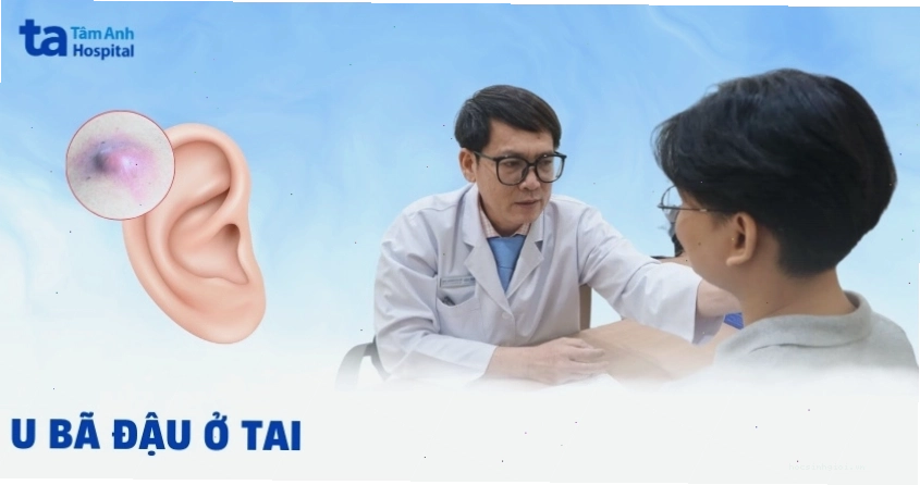 U bã đậu ở tai: Nguyên nhân, hình ảnh, chẩn đoán, cách điều trị