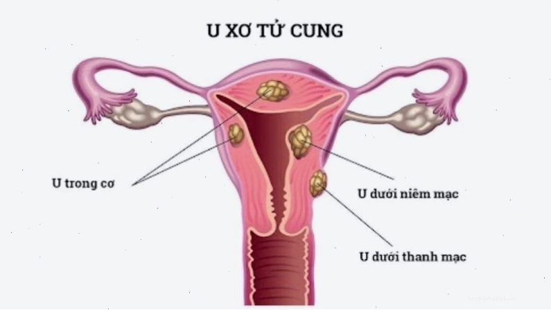 U xơ tử cung có thể gây đau bụng kinh dữ dội