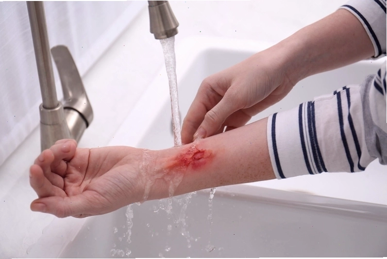Vaseline tạo lớp màng bảo vệ và giữ ẩm cho vết bỏng