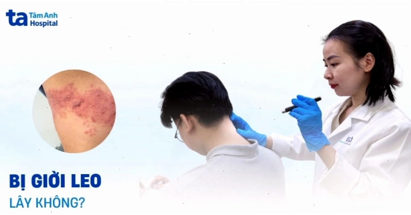 Virus gây bệnh giời leo Varicella-Zoster