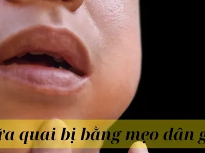 Những cách chữa quai bị bằng mẹo dân gian được áp dụng nhiều