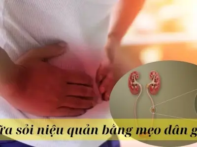 Cách chữa sỏi niệu quản bằng mẹo dân gian không cần thuốc