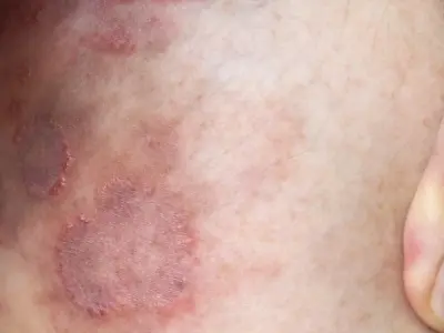 Bật mí mẹo chữa hắc lào dân gian hiệu quả nhanh tại nhà