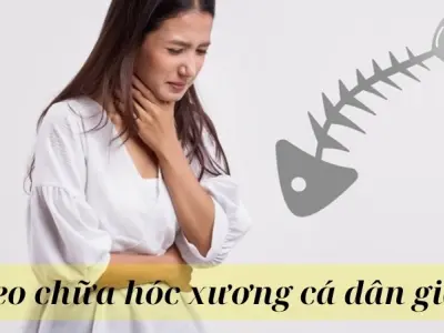 Mẹo chữa hóc xương cá dân gian hiệu quả ai cũng nên biết