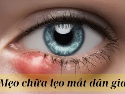Tổng hợp mẹo chữa lẹo mắt dân gian đơn giản, dễ làm