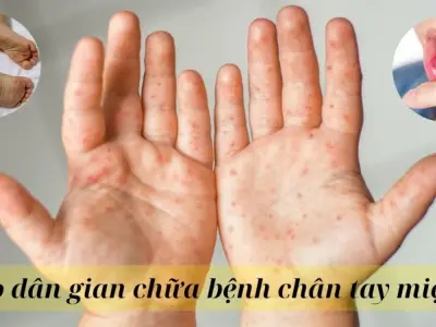 Chia sẻ mẹo dân gian chữa bệnh chân tay miệng từ dân gian xưa