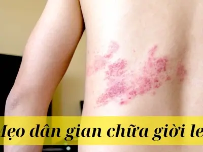 Mẹo dân gian chữa giời leo nhanh khỏi không để lại sẹo