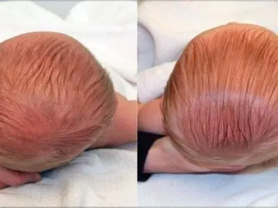 Mẹo dân gian chữa méo đầu ở trẻ sơ sinh an toàn tại nhà