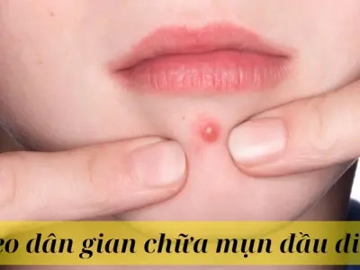 Gợi ý mẹo dân gian chữa mụn đầu đinh nhanh và tiết kiệm