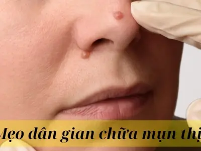 Chia sẻ mẹo dân gian chữa mụn thịt cực kỳ đơn giản tại nhà