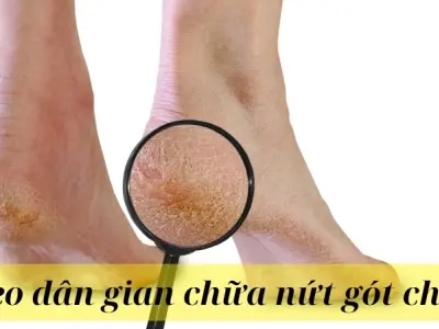 Tổng hợp mẹo dân gian chữa nứt gót chân ai cũng làm được