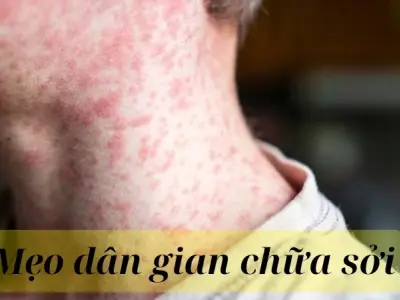 Tìm hiểu mẹo dân gian chữa sởi từ thảo dược truyền thống