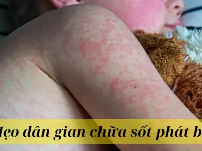 Những mẹo dân gian chữa sốt phát ban nhanh chóng tại nhà