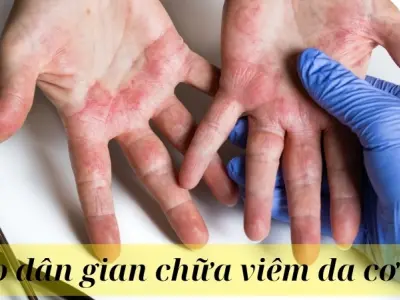 Các mẹo dân gian chữa viêm da cơ địa phổ biến nhất