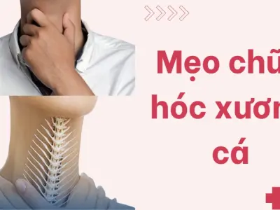 Mẹo chữa hóc xương cá đơn giản nhưng ít ai biết tới
