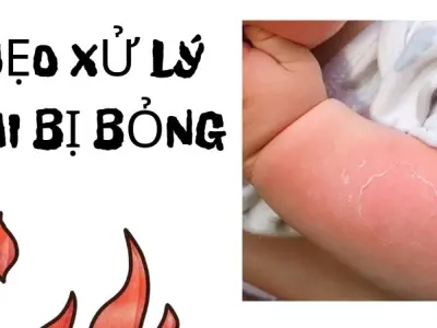 Mẹo xử lý khi bị bỏng tại nhà giúp giảm đau nhanh