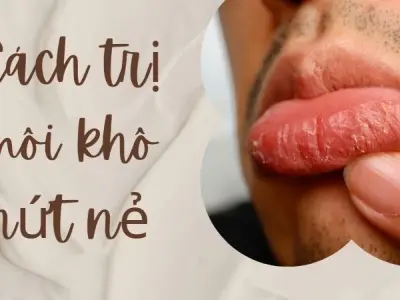 Cách trị môi khô nứt nẻ dứt điểm không cần son dưỡng