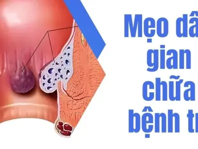 Mẹo dân gian chữa bệnh trĩ tại nhà đơn giản ai cũng làm được